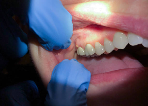 Best Emergency Dental Care for Broken or Chipped Teeth in Arlington, NY